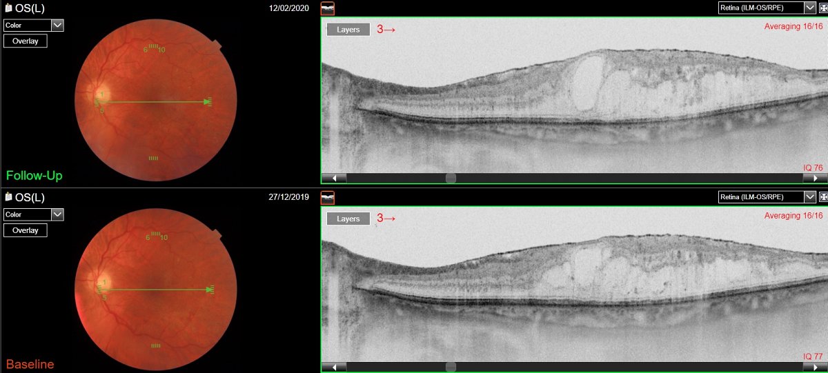 EDEMA MACULARE DIABETICO