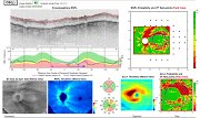 OCT in glaucoma report di Hood